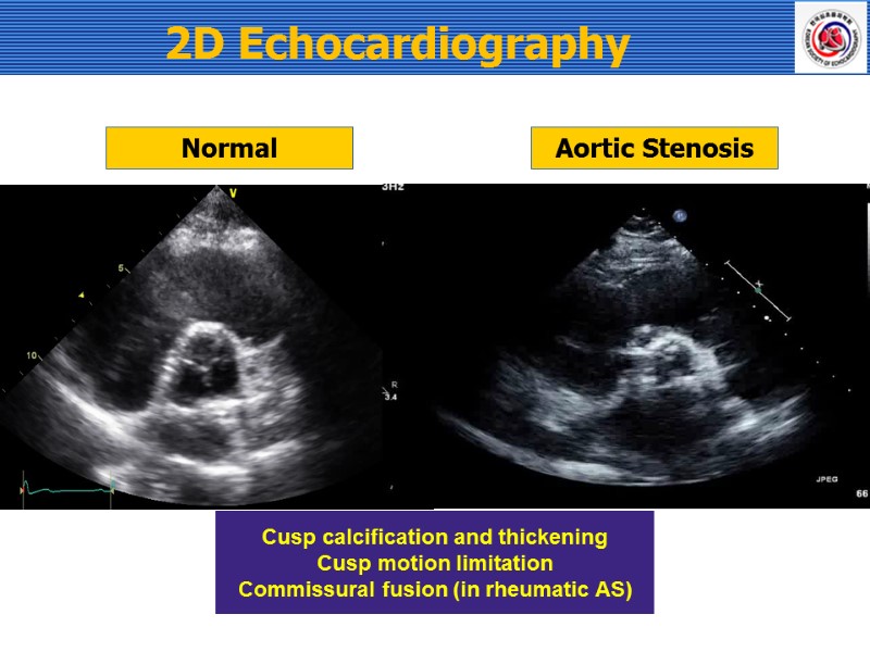 Normal Aortic Stenosis Cusp calcification and thickening Cusp motion limitation Commissural fusion (in rheumatic